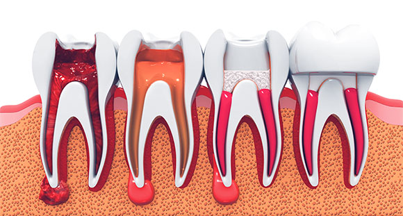 A dental model depicting a tooth structure with a root canal tool inserted, showcasing details of the tooth anatomy for educational purposes.